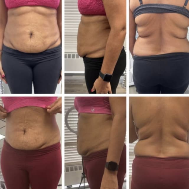 Non-invasive Body Contouring 